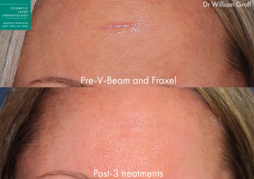 laser scar removal results in San Diego, CA 