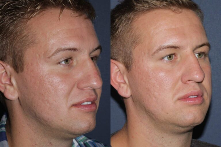 Before and after oblique image of LaViv filler treatment on a male's smile lines performed by Dr. Fabi at our San Diego medical clinic