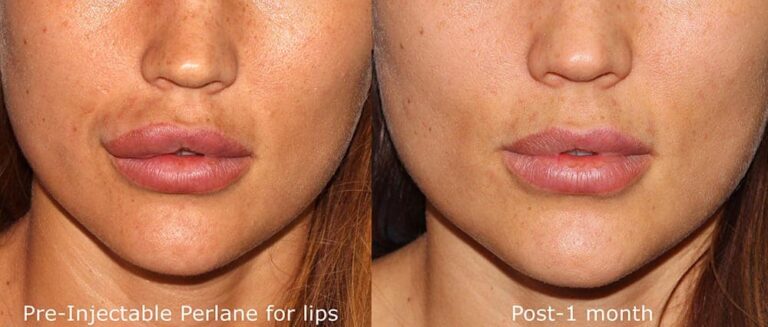 Before and after front image of lip filler correction on a female's lips performed by Dr. Groff at our San Diego medi spa
