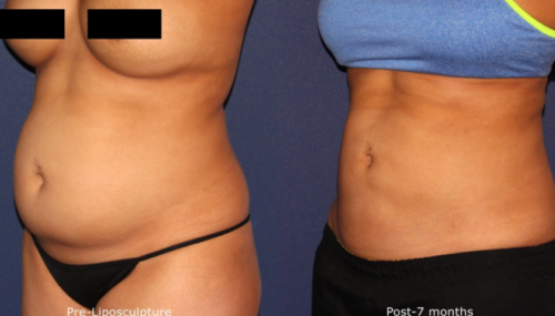 liposculpture before and after in san diego, ca