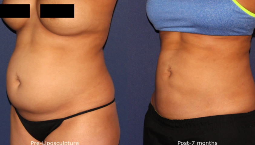 Liposuction vs. Liposculpture: Which Option is Best For Your Body?