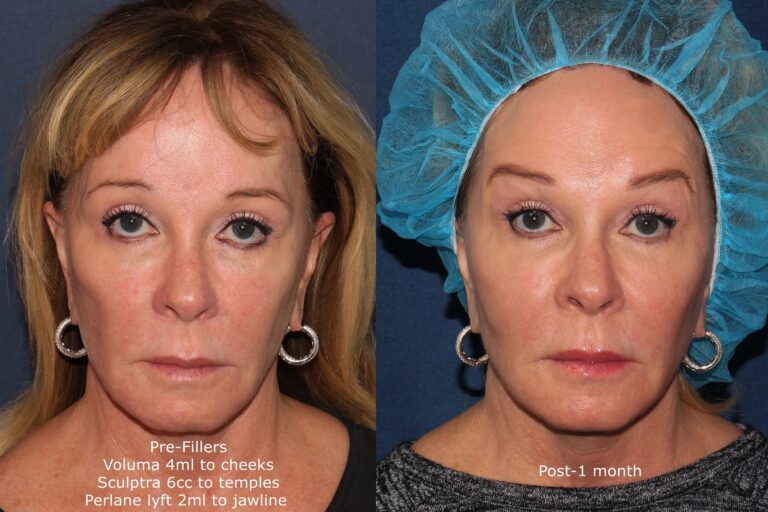 Before and after front image of liquid facelift treatment on a female's face performed by Dr. Fabi at our San Diego medical spa