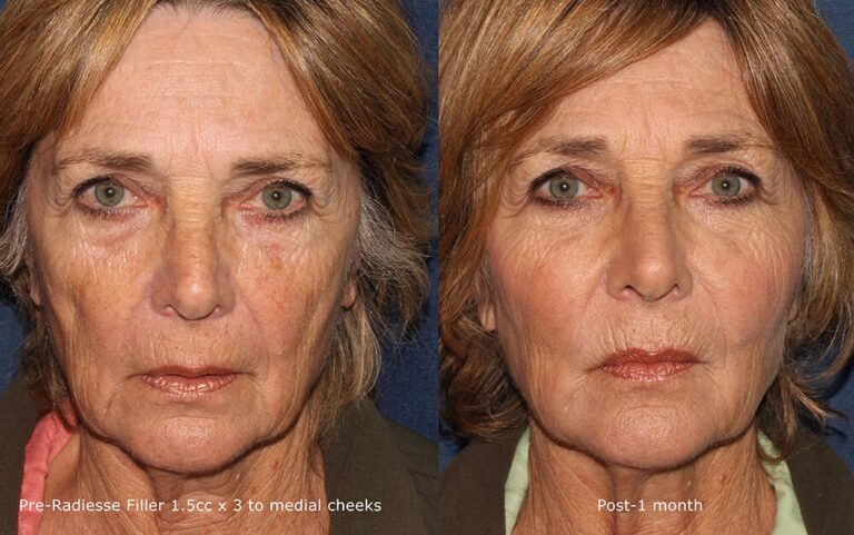 Before and after front image of Radiesse treatment on a female's face performed by Dr. Butterwick at our San Diego medical clinic