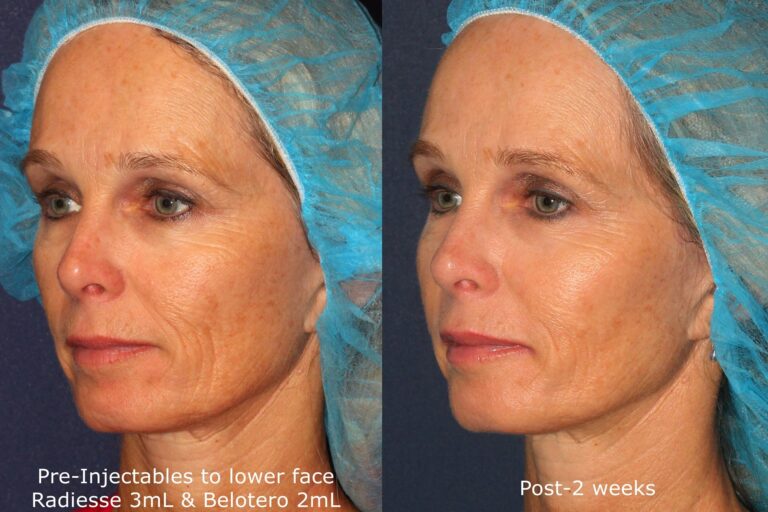 Before and after oblique image of Radiesse and Belotero treatment on a female's face performed by Dr. Fabi at our San Diego medical spa