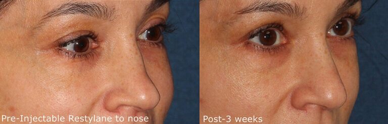 Before and after oblique image of Restylane treatment on a female's nose bump performed by Dr. Groff at our San Diego medical clinic