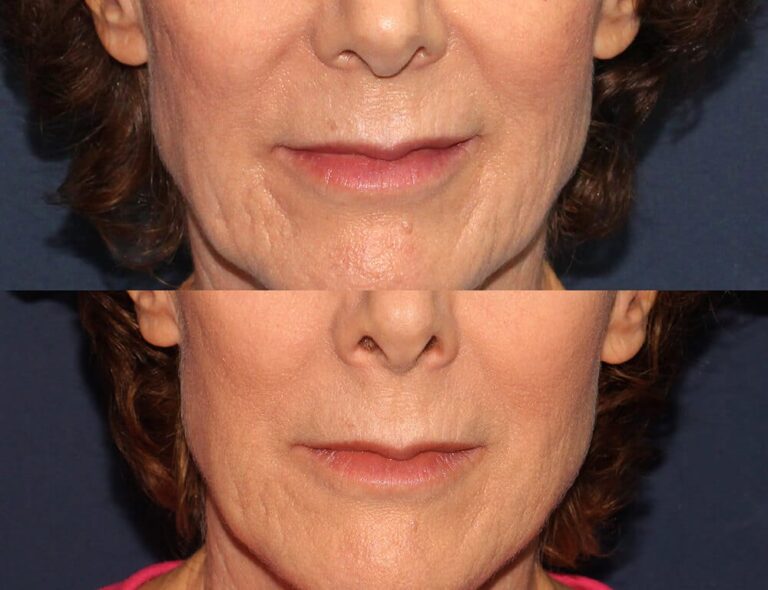 Before and after front image of Restylane Defyne treatment on a female's lower face performed by Dr. Fabi at our San Diego medical clinic