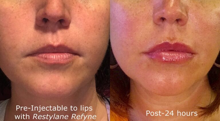 Before and after front image of Restylane Refyne treatment on a female's lips performed by Dr. Goldman at our San Diego medical spa