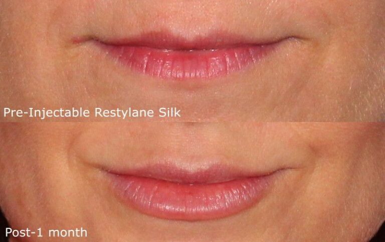 Before and after front image of Restylane Silk treatment on a female's lips performed by Dr. Fabi at our San Diego medical spa