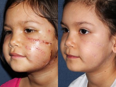 Before and after laser treatment on a child's face for a dog bite scar performed by Dr. Goldman at our San Diego medical clinic