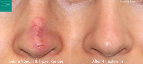 revision scar treatment results in San Diego