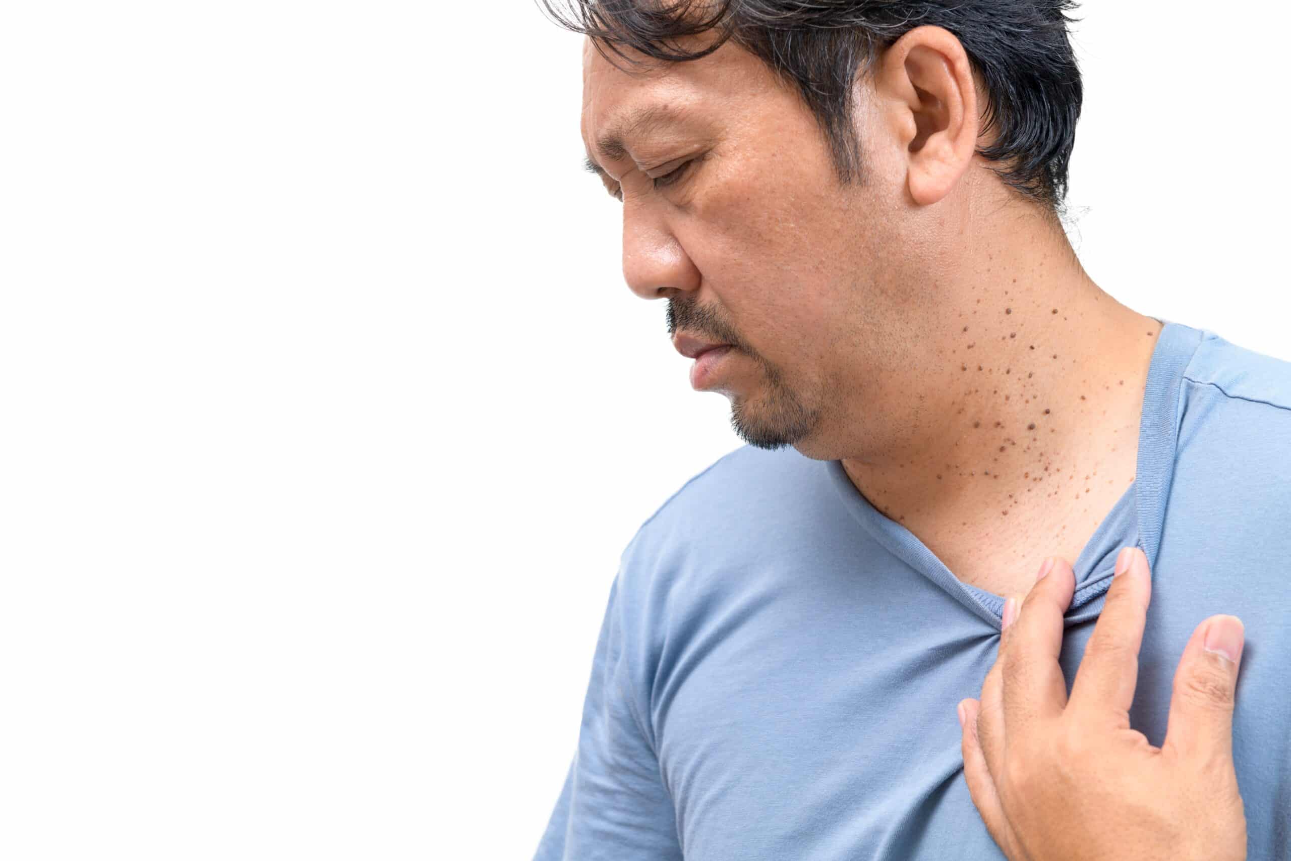 Man with seborrheic keratosis seeking treatment in San Diego