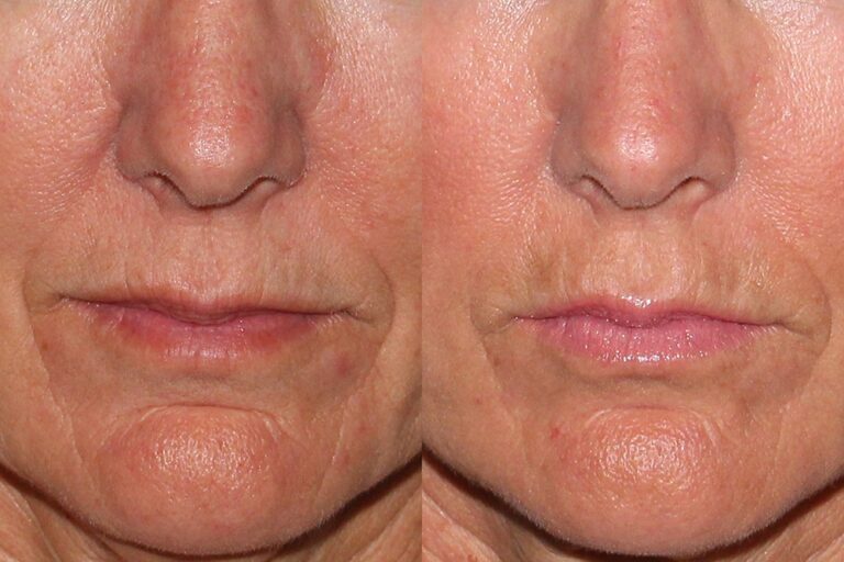 Before and after front image of Belotero treatment on a male's perioral lines performed by Dr. Wu at our San Diego medical spa