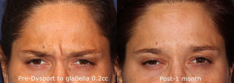 Before and after front image of Dysport treatment on a female's glabellar lines performed by Dr. Wu at our San Diego medical spa