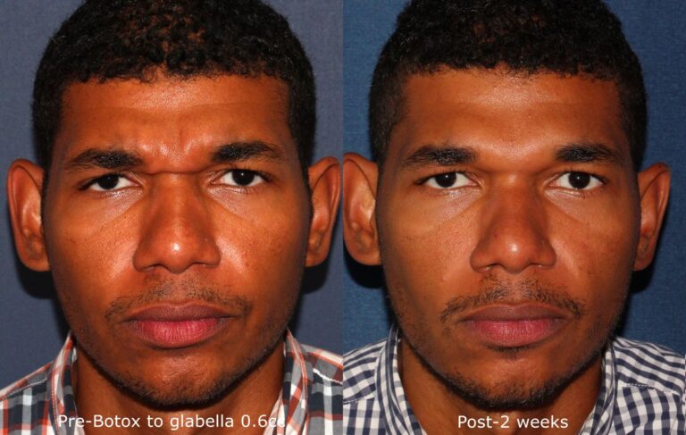Before and after front image of Botox treatment on a male's glabellar lines performed by Dr. Wu at our San Diego medical clinic