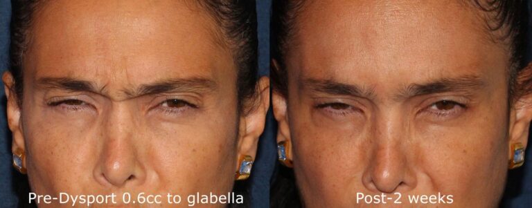 Before and after front image of Dysport treatment on a female's glabellar lines performed by Dr. Wu at our San Diego medical clinic