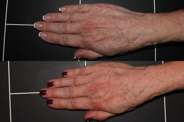 Before and after front image of Radiesse treatment on a female's hands performed by Dr. Wu at our San Diego medical spa