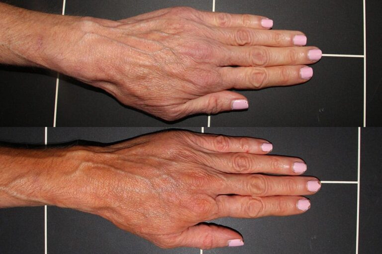 Before and after front image of Radiesse treatment on a female's hands performed by Dr. Wu at our San Diego medical spa