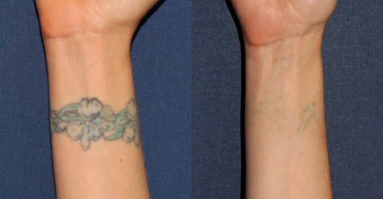 Before and after front image of laser tattoo removal on a female's wrist performed by Dr. Wu at our San Diego medical spa