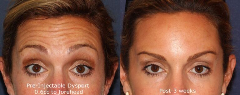 Before and after front image of Dysport treatment on a female's forehead lines performed by Dr. Wu at our San Diego medical clinic
