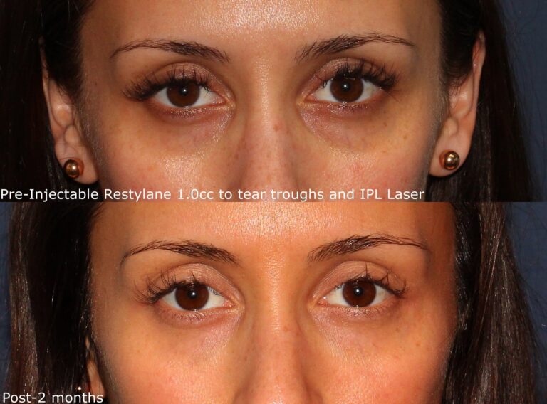 Before and after front image of Restylane treatment on a female's hollowing under the eyes performed by Dr. Wu at our San Diego medical spa