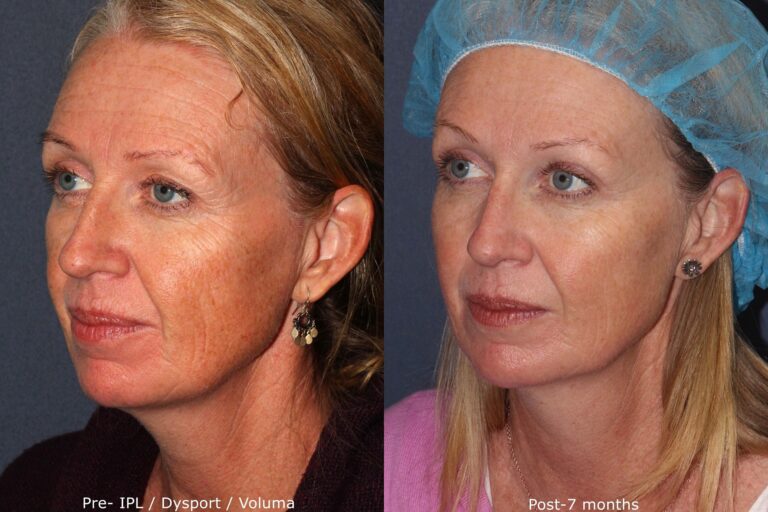 Before and after oblique image of IPL, Dysport, and Voluma treatment on a female's face performed by Dr. Fabi at our San Diego medical spa