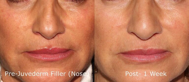 Before and after front image of Juvederm treatment on a female's nose performed by Dr. Goldman at our San Diego medi spa
