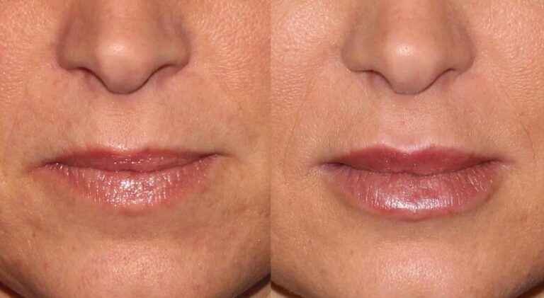 Before and after front image of Juvederm treatment on a female's lips performed by Dr. Wu at our San Diego med spa
