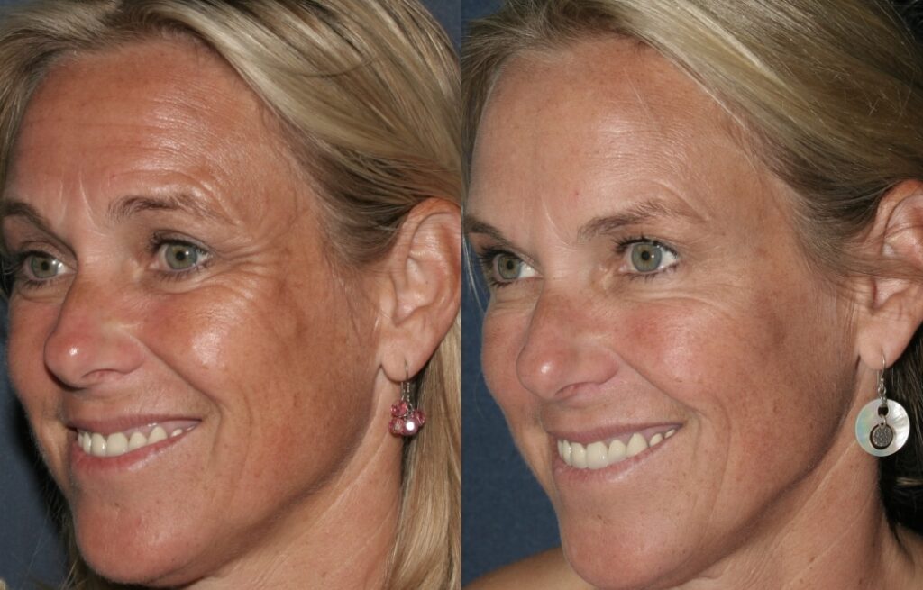 Actual un-retouched patient before and after Sculptra, IPL, Volbella, Clear + Brilliant and Dysport for facial rejuvenation by Dr. Fabi. Disclaimer: Results may vary from patient to patient. Results are not guaranteed.
