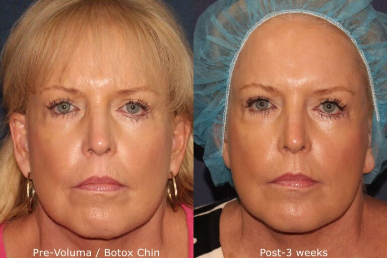 Before and after front image of Botox treatment on a female's chin and jawline performed by Dr. Fabi at our San Diego medical spa