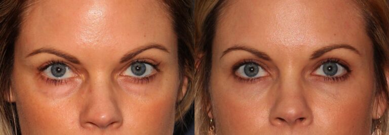 Before and after front image of Voluma treatment on a female's hollowing under the eyes performed by Dr. Groff at our San Diego medical spa