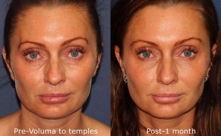 Before and after front image of Voluma treatment on a female's temples performed by Dr. Wu at our San Diego med spa
