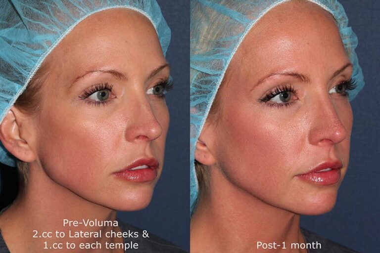 Before and after oblique image of Voluma treatment on a female's temples and cheeks performed by Dr. Groff at our San Diego med spa