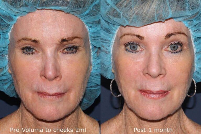 Before and after front image of Voluma treatment on a female's cheeks performed by Dr. Fabi at our San Diego med spa