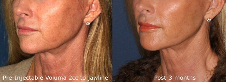 Before and after oblique image of Voluma treatment on a female's jawline performed by Dr. Butterwick at our San Diego med spa