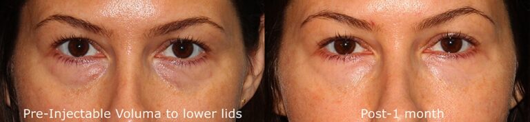 Before and after front image of Voluma treatment on a female's hollowing under the eyes performed by Dr. Groff at our San Diego med spa