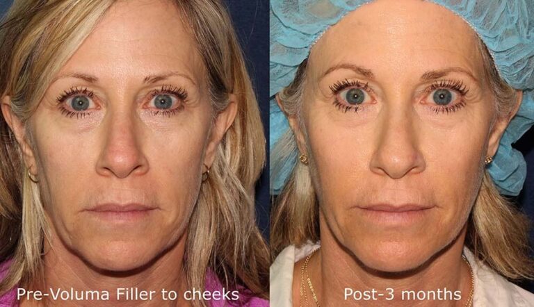 Before and after front image of Voluma treatment on a female's cheeks performed by Dr. Fabi at our San Diego med spa