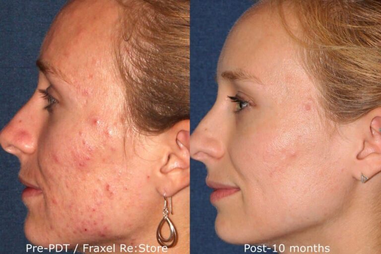 Before and after side image of photodynamic therapy and Fraxel Re:store treatment on a female's acne performed by Dr. Fabi at our San Diego medical spa