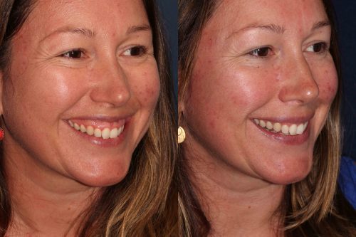 Before and after oblique image of Botox treatment on a female's gummy smile performed by Dr. Butterwick at our San Diego medical spa