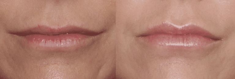 Before and after front image of Juvederm treatment on a female's lips and lower face performed by Dr. Fabi at our San Diego medical spa