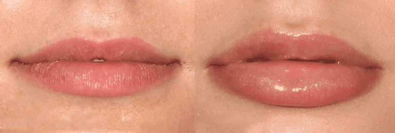 Before and after front image of dermal filler treatment on a female's lips performed by Dr. Fabi at our San Diego medical clinic