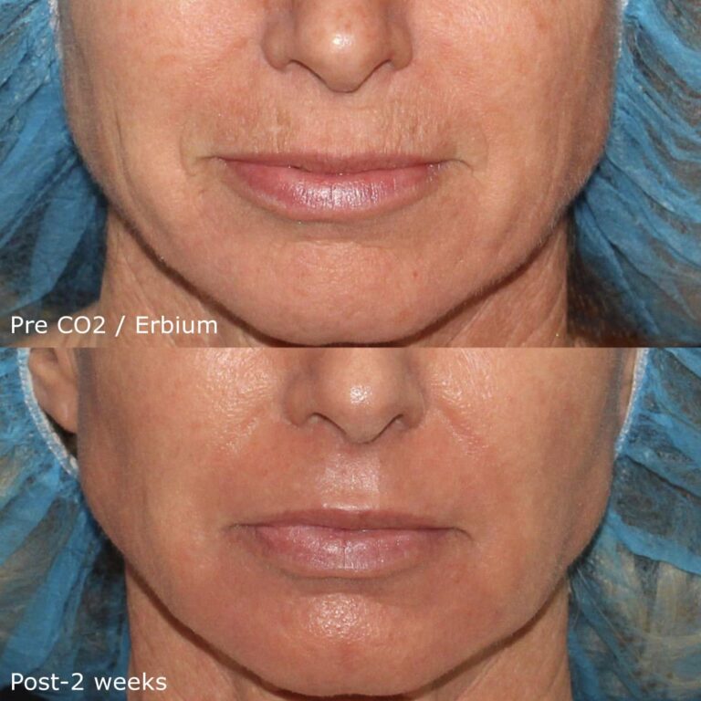 Before and after front image of CO2 laser treatment on a female's lower face performed by Dr. Groff at our San Diego medical spa