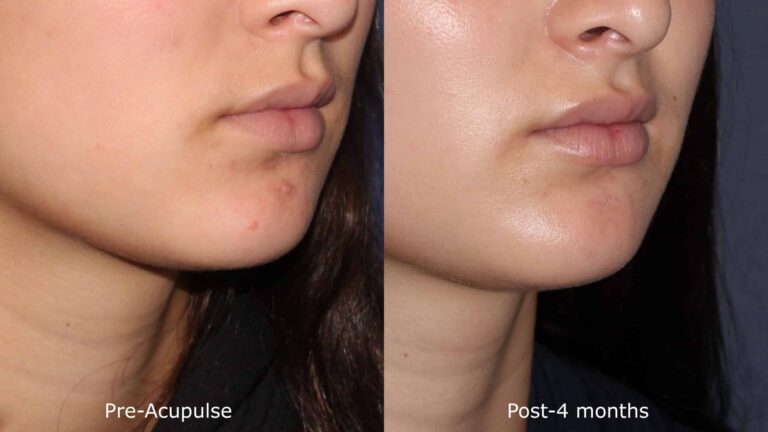 Before and after oblique image of Aculpulse laser treatment on a female's face performed by Dr. Goldman at our San Diego medi spa