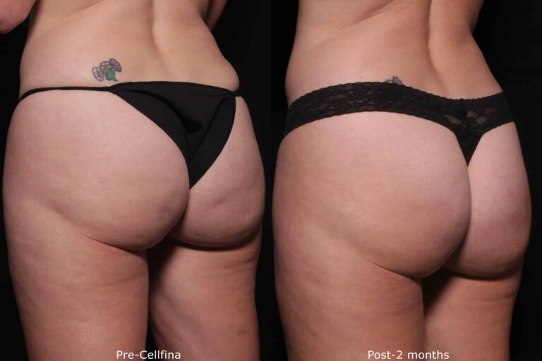 Before and after oblique image of Cellfina treatment on a female's buttocks performed by Dr. Fabi at our San Diego medical clinic