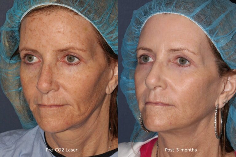 Before and after oblique image of CO2 laser treatment on a female's face performed by Dr. Wu at our San Diego medi spa