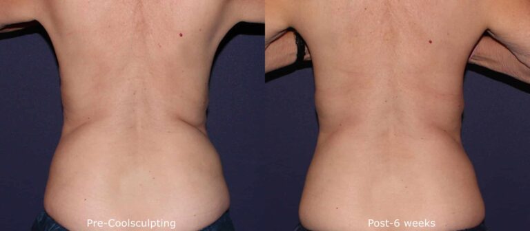 Before and after back image of CoolSculpting treatment on a female's back performed by Leysin Fletcher, PA-C, at our San Diego med spa