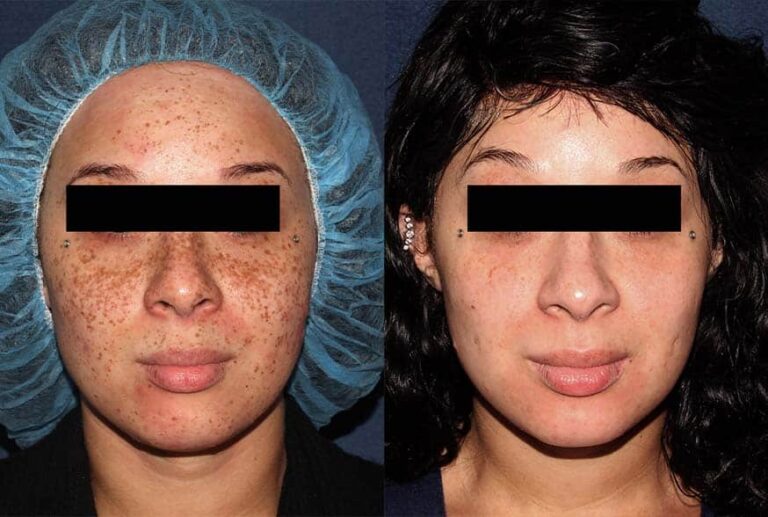 Before and after front image of Fraxel treatment on a female's face performed by Dr. Groff at our San Diego medi spa