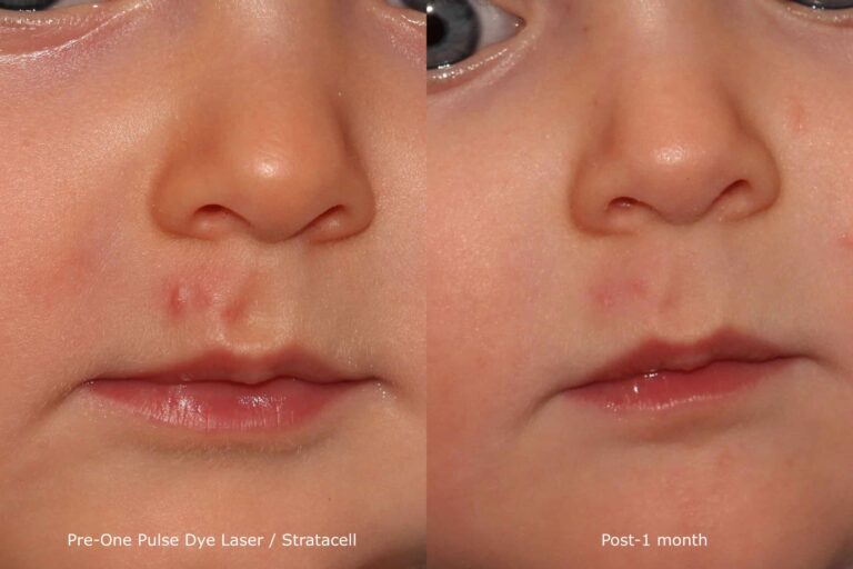 Before and after front image of pulse-dye laser treatment on a baby's face performed by Dr. Goldman at our San Diego medical spa