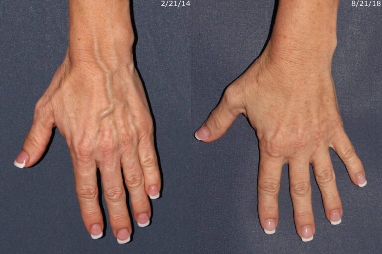Before and after front image of sclerotherapy treatment on a female's hands performed by Dr. Goldman at our San Diego medical spa
