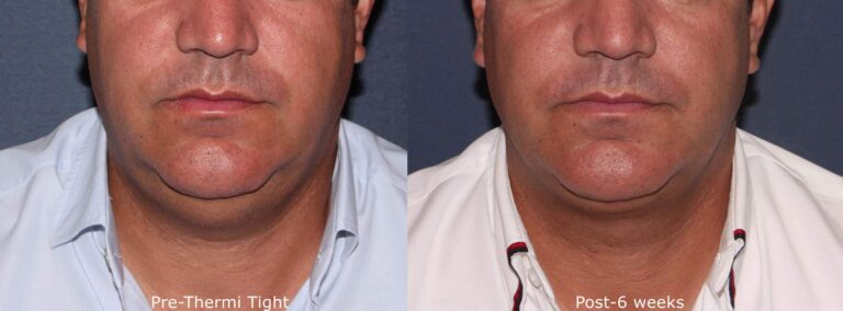 Before and after front image of ThermiTight treatment on a male's jawline performed by Dr. Groff at our San Diego medical spa