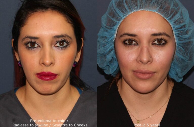 Before and after front image of Voluma treatment on a female's chin performed by Dr. Fabi at our San Diego medi spa